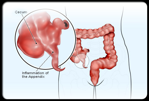 Appendicitis & Appendectomy Pictures ~ Your doctor colon wall diagram 